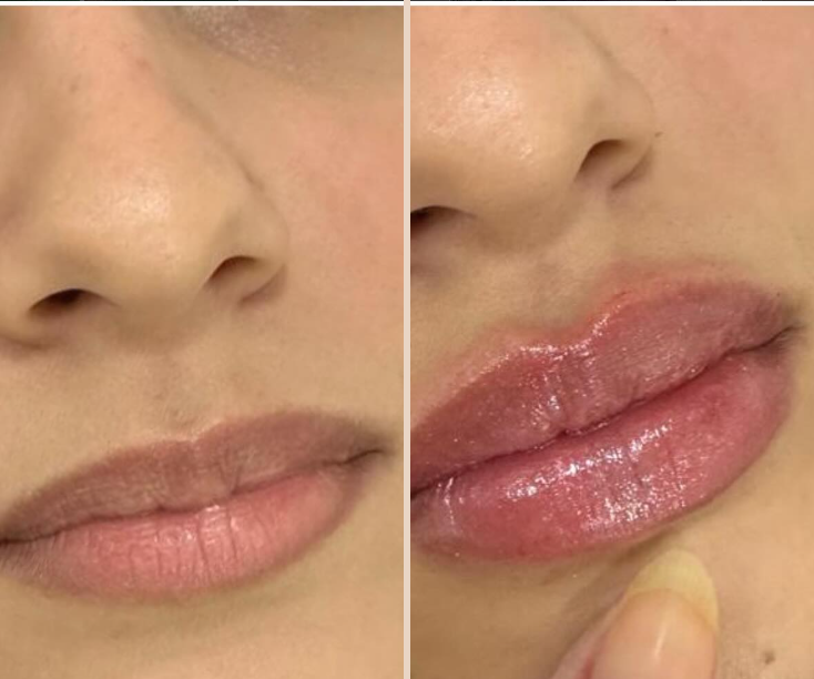 Comparativo antes e depois de preenchimento labial