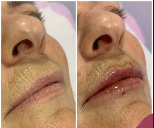Comparativo antes e depois de preenchimento labial