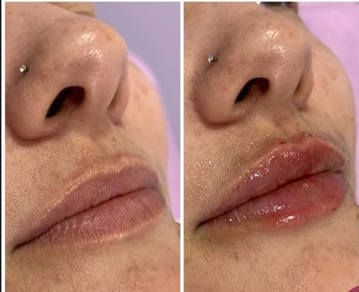 Comparativo antes e depois de preenchimento labial