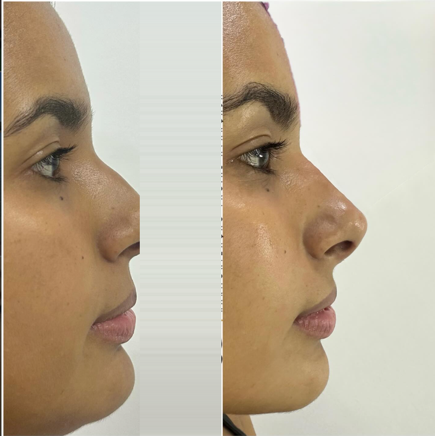 Comparativo antes e depois de rinomodelação