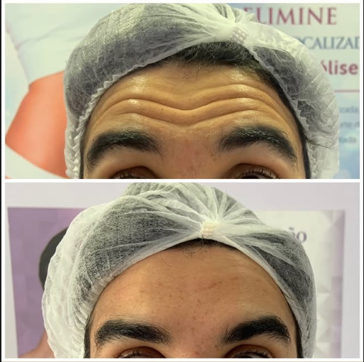 Comparativo antes e depois de toxina botulínica na região frontal