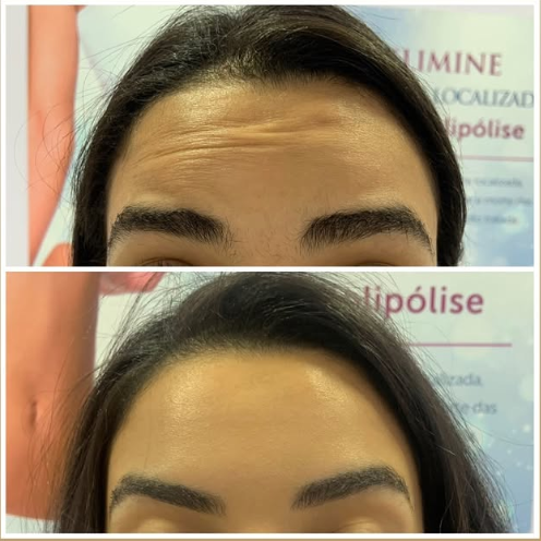 Comparativo antes e depois de toxina botulínica na região frontal